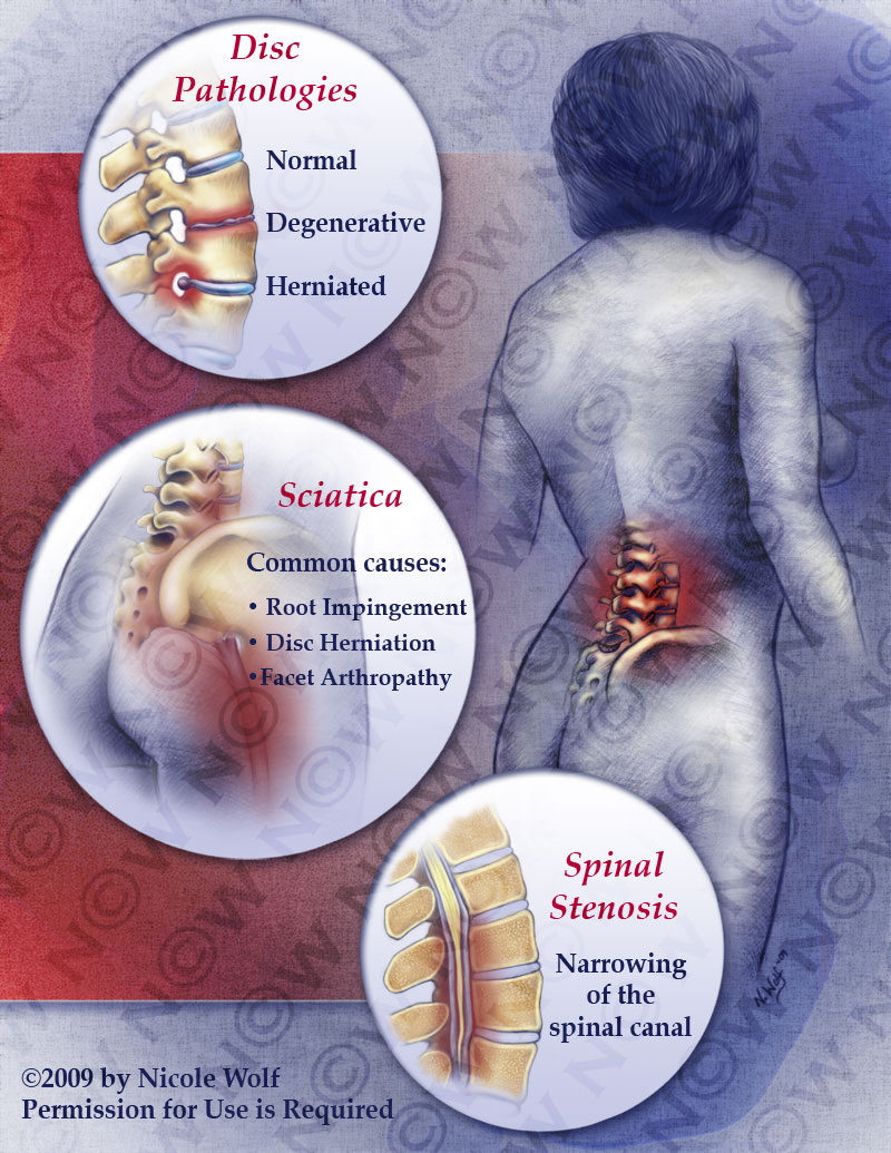 Nicole Wolf Back Pain